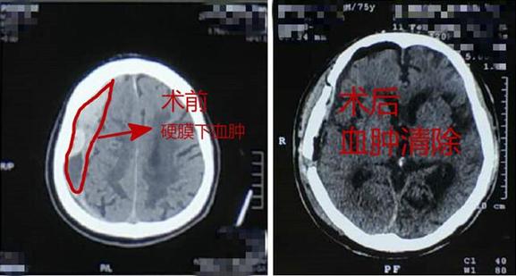 意外磕到頭不重視 當(dāng)心出大問(wèn)題