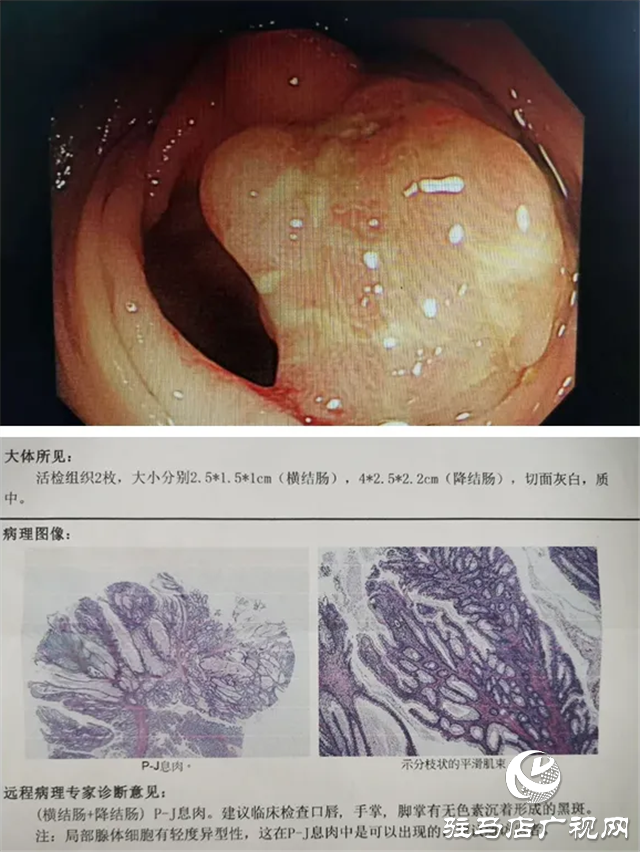 “黑痣”長(zhǎng)在嘴上，息肉生在腸內(nèi)！市中心醫(yī)院專家為一罕見(jiàn)病患者內(nèi)鏡下切除30多處腸道腫物