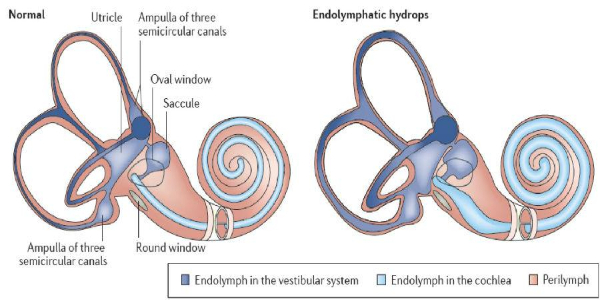 “耳水不平衡”是什么??？